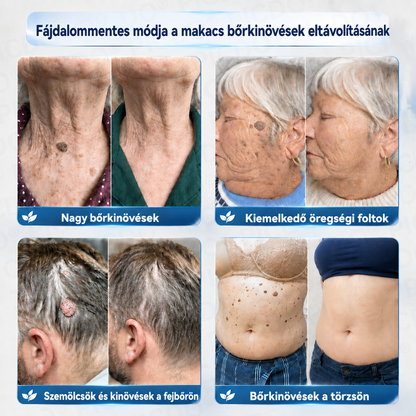 👨‍⚕️🌼𝐏𝐢𝐜𝐝𝐨® 𝟕 𝐧𝐚𝐩 𝐒𝐳𝐞𝐦ö𝐥𝐜𝐬- é𝐬 𝐟𝐨𝐥𝐭𝐞𝐥𝐭á𝐯𝐨𝐥í𝐭ó 𝐤𝐫é𝐦🩵 (Zero Pain, Zero 𝐒𝐜𝐚𝐫𝐬 Formula)