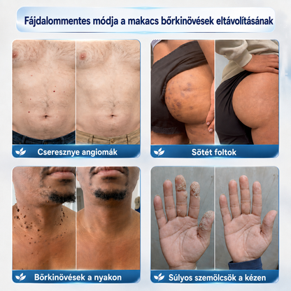 👨‍⚕️🌼𝐏𝐢𝐜𝐝𝐨® 𝟕 𝐧𝐚𝐩 𝐒𝐳𝐞𝐦ö𝐥𝐜𝐬- é𝐬 𝐟𝐨𝐥𝐭𝐞𝐥𝐭á𝐯𝐨𝐥í𝐭ó 𝐤𝐫é𝐦🩵 (Zero Pain, Zero 𝐒𝐜𝐚𝐫𝐬 Formula)