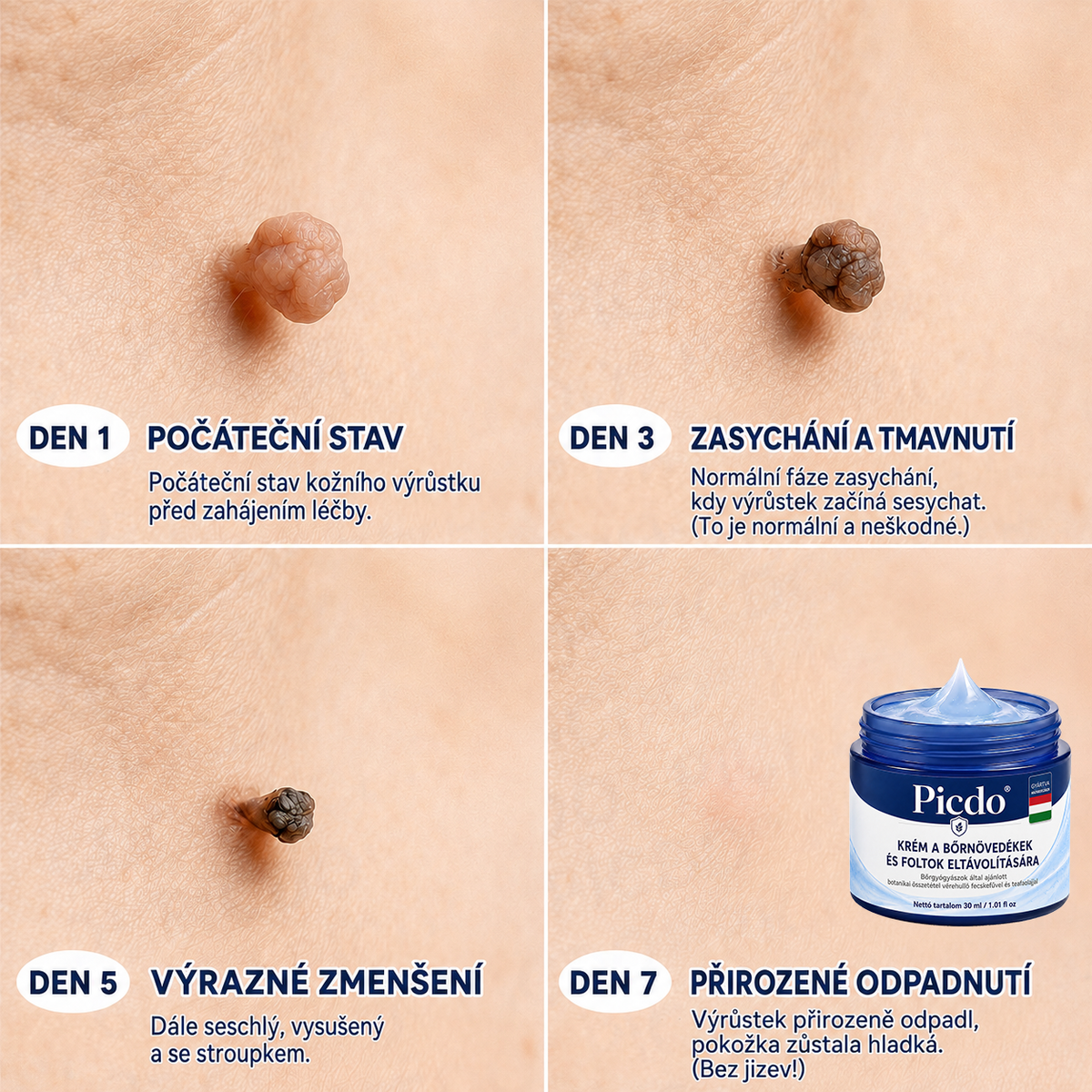 👨‍⚕️🌼𝐏𝐢𝐜𝐝𝐨® 𝟕 𝐧𝐚𝐩 𝐒𝐳𝐞𝐦ö𝐥𝐜𝐬- é𝐬 𝐟𝐨𝐥𝐭𝐞𝐥𝐭á𝐯𝐨𝐥í𝐭ó 𝐤𝐫é𝐦🩵 (Zero Pain, Zero 𝐒𝐜𝐚𝐫𝐬 Formula)