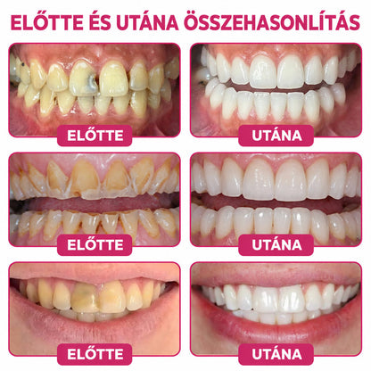 ⭐👨‍⚕️🦷HEATWOLF® DenPerm – Természetes fogzománc-töltő gél a fogszuvasodás helyreállítására🐟1️⃣