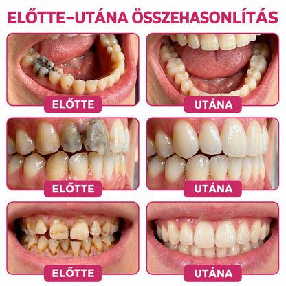 ⭐👨‍⚕️🦷HEATWOLF® DenPerm – Természetes fogzománc-töltő gél a fogszuvasodás helyreállítására🐟1️⃣