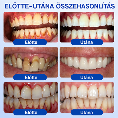🦷🥑𝑮𝒍𝒊𝒎𝒎𝒆𝒓𝒍𝒚®  ÍNYMEGÚJÍTÓ – Parodontális helyreállító gél