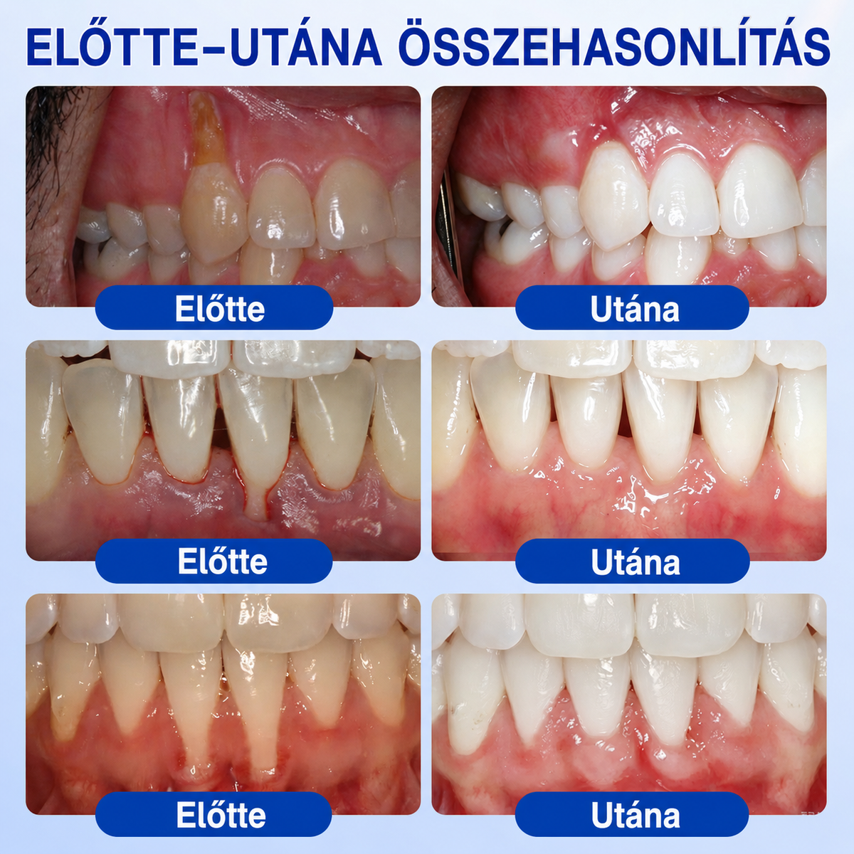 🦷🥑𝑮𝒍𝒊𝒎𝒎𝒆𝒓𝒍𝒚®  ÍNYMEGÚJÍTÓ – Parodontális helyreállító gél