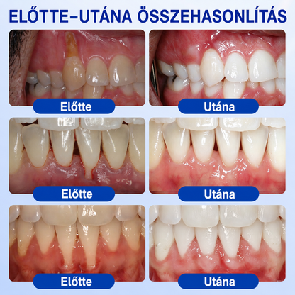 🦷🥑𝑮𝒍𝒊𝒎𝒎𝒆𝒓𝒍𝒚®  ÍNYMEGÚJÍTÓ – Parodontális helyreállító gél